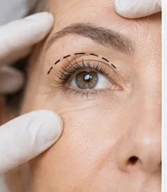 Blefaroplastia Superior — quadro ilustrativo de soluções