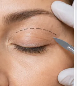 Blefaroplastia Transcutânea — quadro ilustrativo de soluções